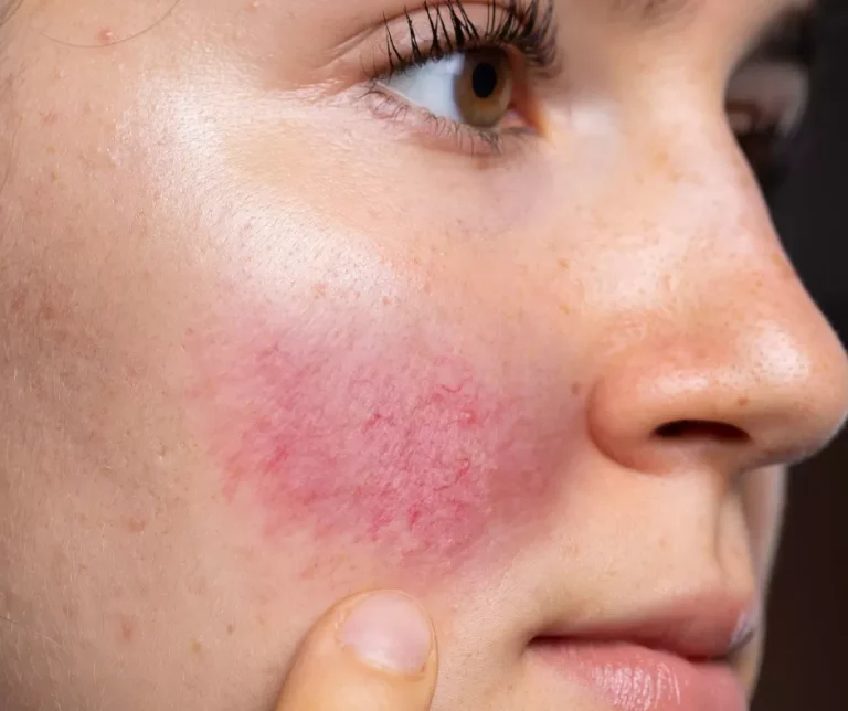 Afecțiuni Dermatologice: Cum Să Tratezi Corect Problemele De Piele