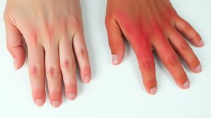 Mână sănătoasă lângă mână inflamată, close-up fotografic.